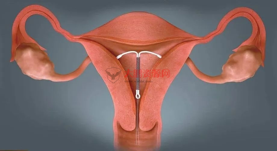 避孕不止安全套,17种避孕方法了解一下好兄弟们插图6 避孕不止安全套,17种避孕方法了解一下好兄弟们插图6